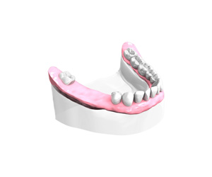 Remplacer plusieurs dents absentes ou abîmées à Maisons-Alfort